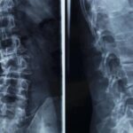 A-Z knowledge about scoliosis