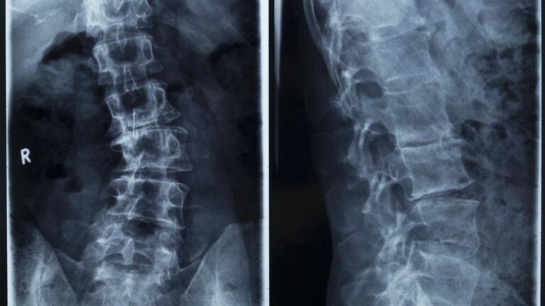 A-Z knowledge about scoliosis