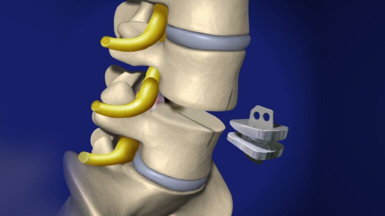 Spinal Disc Replacement